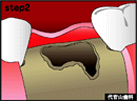 step2