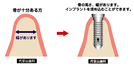 骨再生・移植 | 骨・歯ぐきが薄くても大丈夫 | 代官山インプラント 