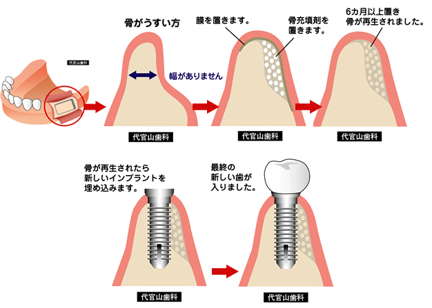 骨再生・移植 | 骨・歯ぐきが薄くても大丈夫 | 代官山インプラント